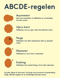 Sjekk føflekkene med ABCDE-regelen. Kilde: Melanomforeningen